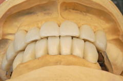 オーバーデンチャーの臨床技工 前歯切縁の位置は試摘時にドクターによって決定された。