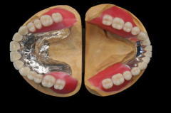 オーバーデンチャーの臨床技工 臼歯 Ａ３ ＡＳ－３１Ｍを使用した。