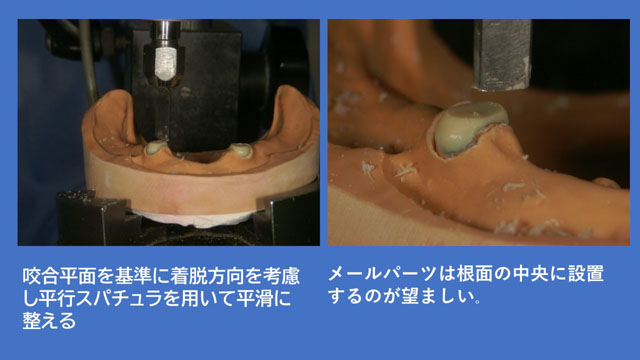 アタッチメントデンチャー CMロック