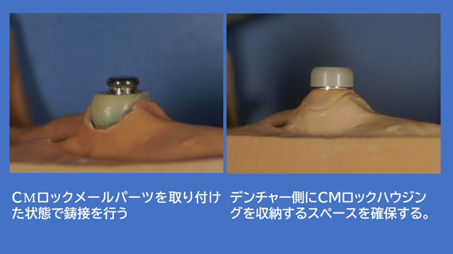 アタッチメントデンチャー CMロック