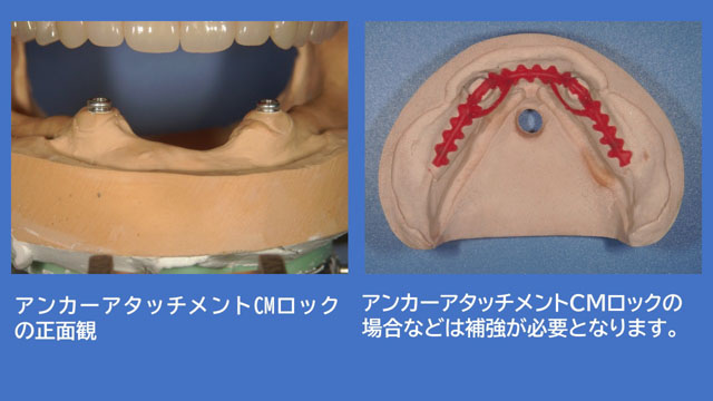 アタッチメントデンチャー CMロック