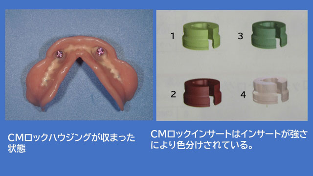 アタッチメントデンチャー CMロック