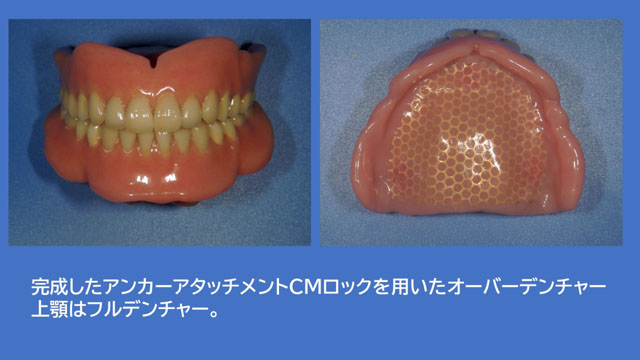 アタッチメントデンチャー CMロック