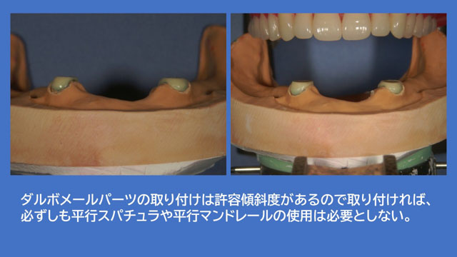 アタッチメントデンチャー ダルボプラス