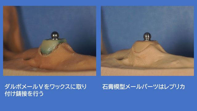 アタッチメントデンチャー ダルボプラス