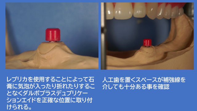 アタッチメントデンチャー ダルボプラス
