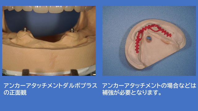 アタッチメントデンチャー ダルボプラス