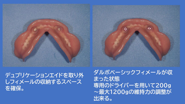 アタッチメントデンチャー ダルボプラス