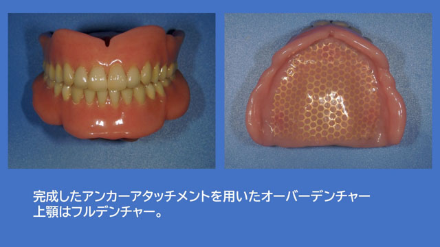 アタッチメントデンチャー ダルボプラス