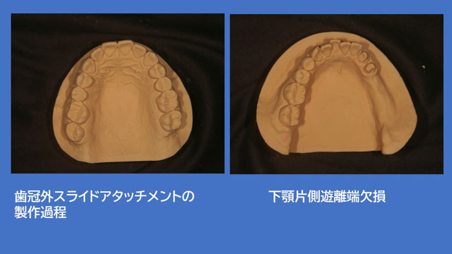 アタッチメントデンチャー 歯冠外アタッチメント