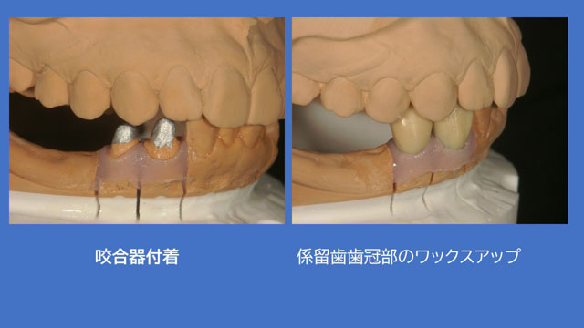 アタッチメントデンチャー 歯冠外アタッチメント