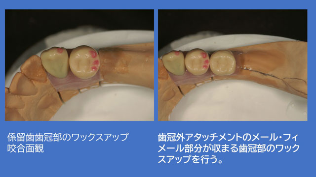 アタッチメントデンチャー 歯冠外アタッチメント