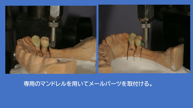 アタッチメントデンチャー 歯冠外アタッチメント