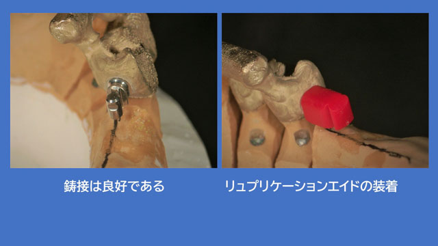アタッチメントデンチャー 歯冠外アタッチメント