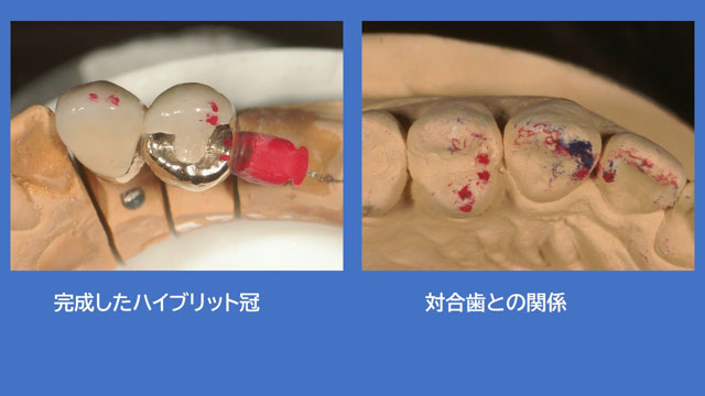 アタッチメントデンチャー 歯冠外アタッチメント