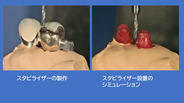 アタッチメントデンチャー 歯冠外アタッチメント