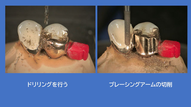 アタッチメントデンチャー 歯冠外アタッチメント