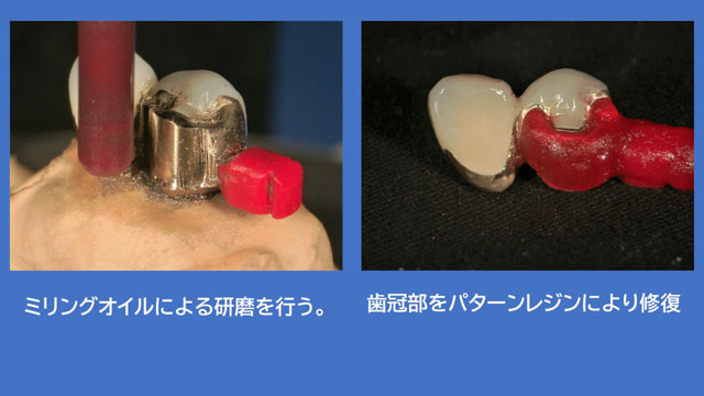 アタッチメントデンチャー 歯冠外アタッチメント
