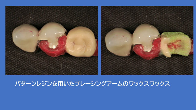 アタッチメントデンチャー 歯冠外アタッチメント