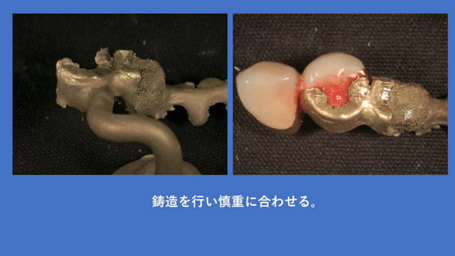 アタッチメントデンチャー 歯冠外アタッチメント