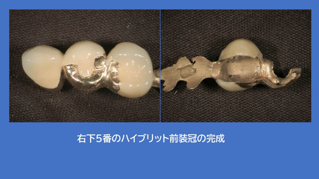 アタッチメントデンチャー 歯冠外アタッチメント