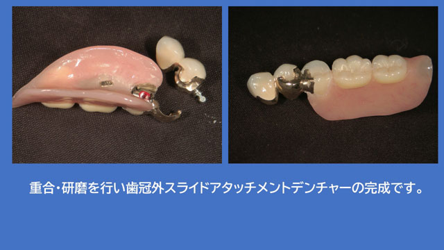 アタッチメントデンチャー 歯冠外アタッチメント