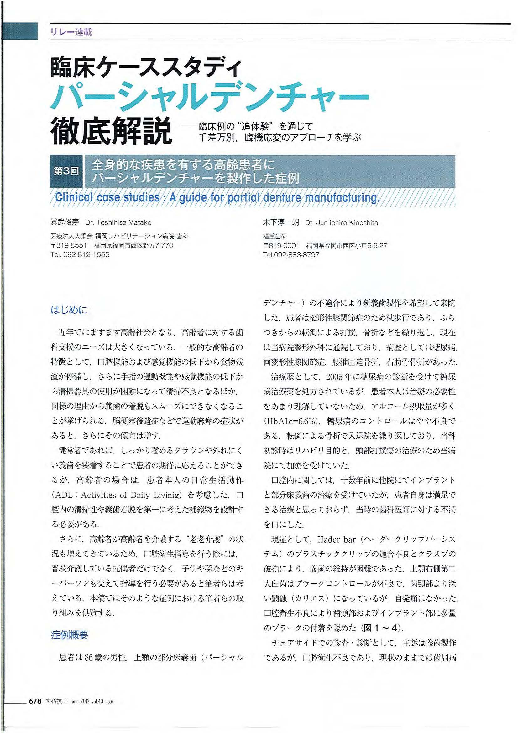 2012年論文・臨床ケーススタディバーシャルデンチャー徹底解説